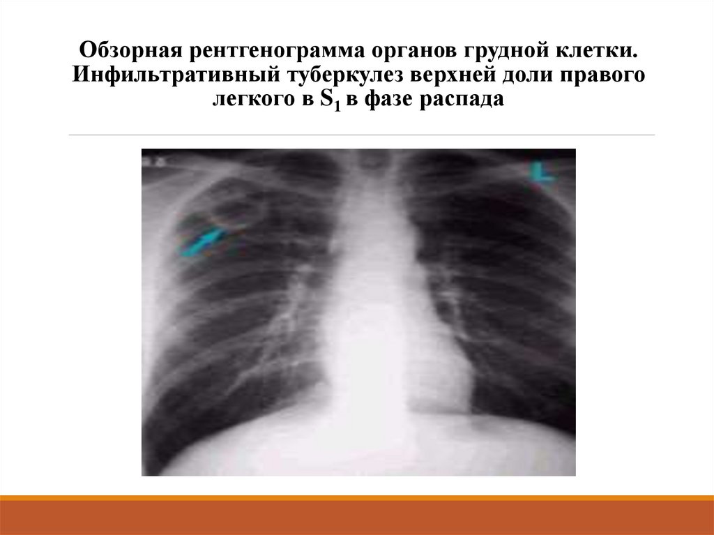 Очаговый и инфильтративный туберкулез презентация