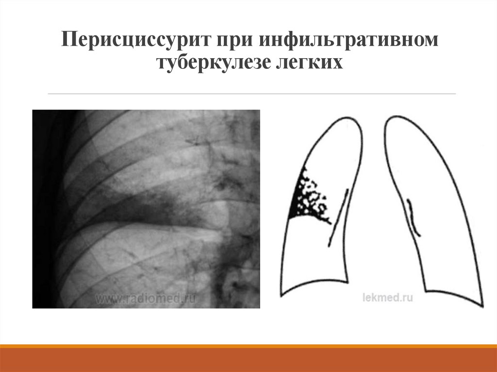 Перисциссурит рентген картина