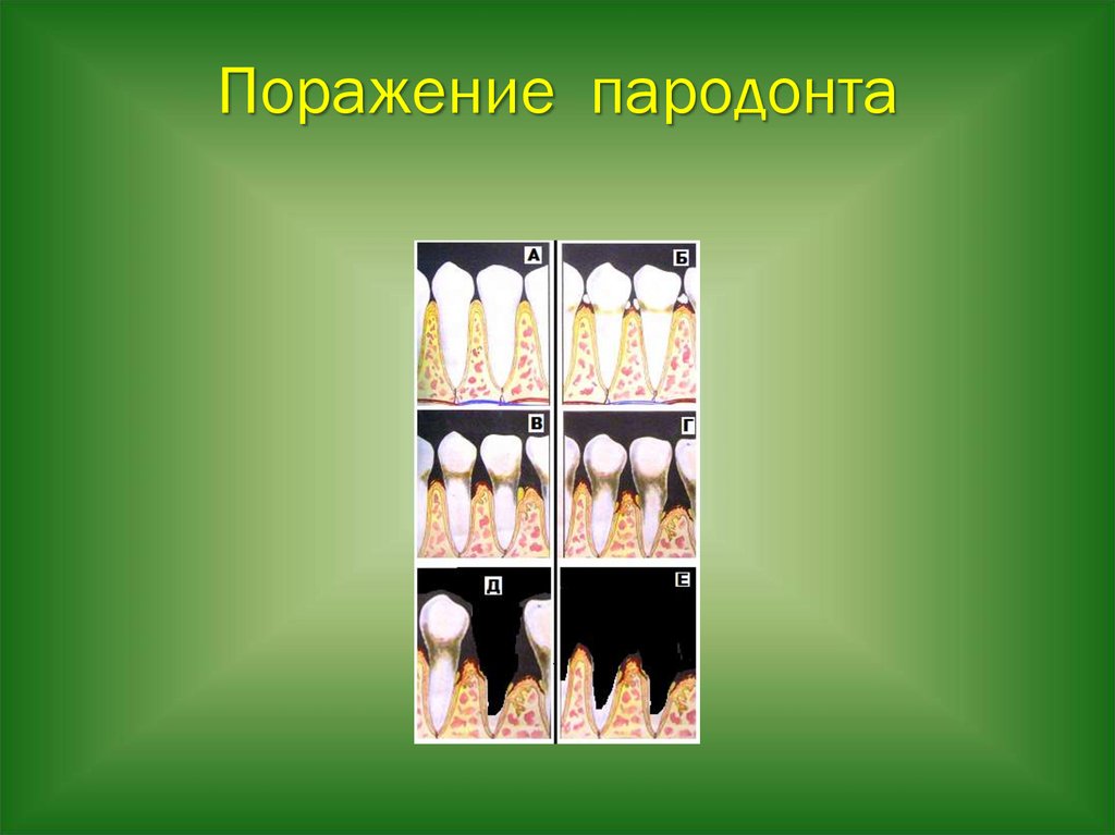 Поражение пародонта