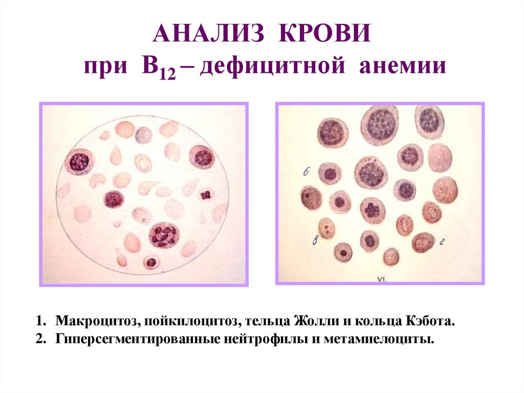 Анемия при в12 дефицитной анемии. Картина костного мозга при в12 дефицитной анемии. Кривая прайс Джонса при в12 дефицитной анемии.