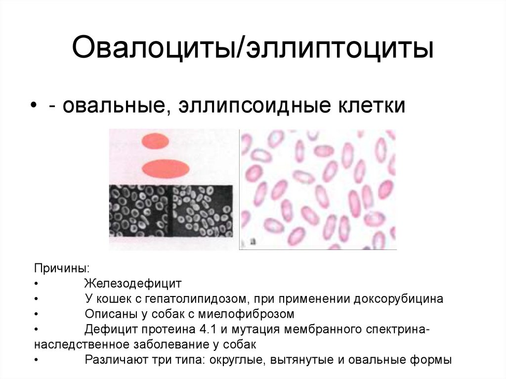 Эллиптоцитоз. Эллиптоциты (овалоциты). Пойкилоцитоз овалоциты. Наследственный эллиптоцитоз. Овалоциты эритроциты.