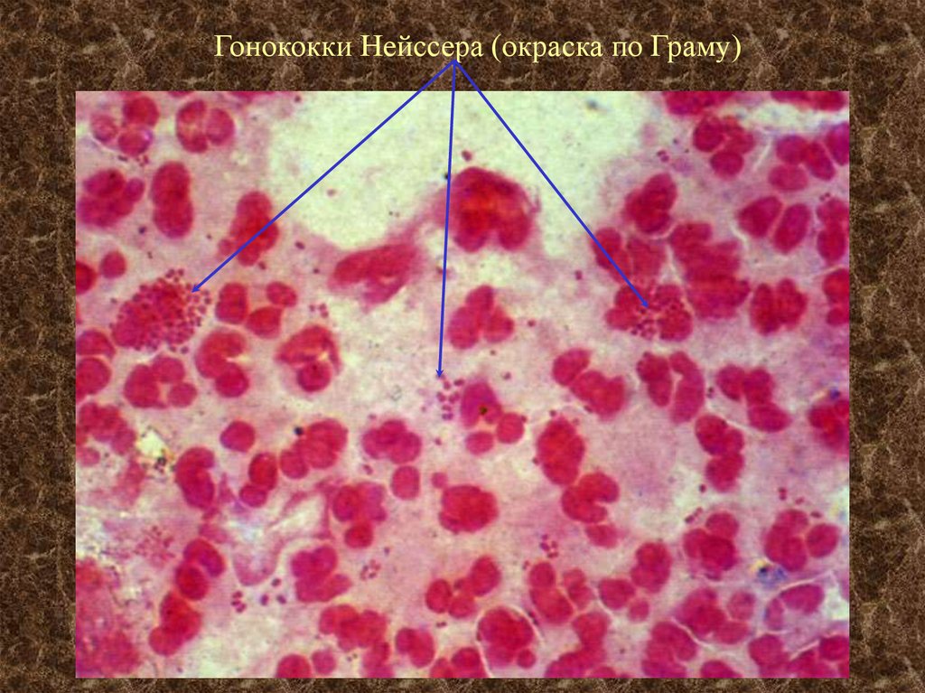 Chlamydia trachomatis neisseria gonorrhoeae. Гонорея окраска по Граму. Окраска по Граму гонорея гонорея.