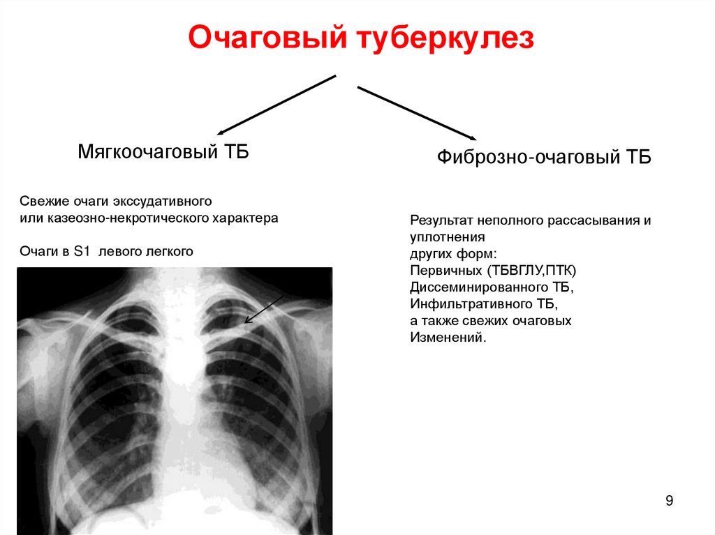 Очаговый туберкулез презентация. Частота очагового туберкулеза. Фиброзно-очаговый туберкулез легких. Очаговый туберкулез характеристика.