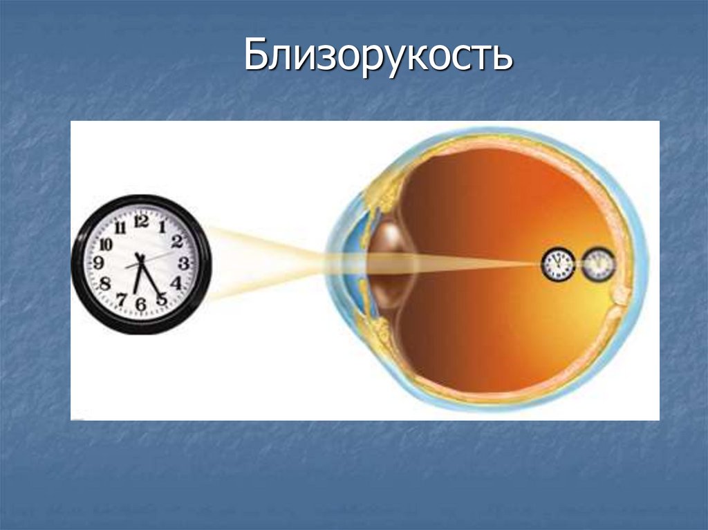 Близорукость