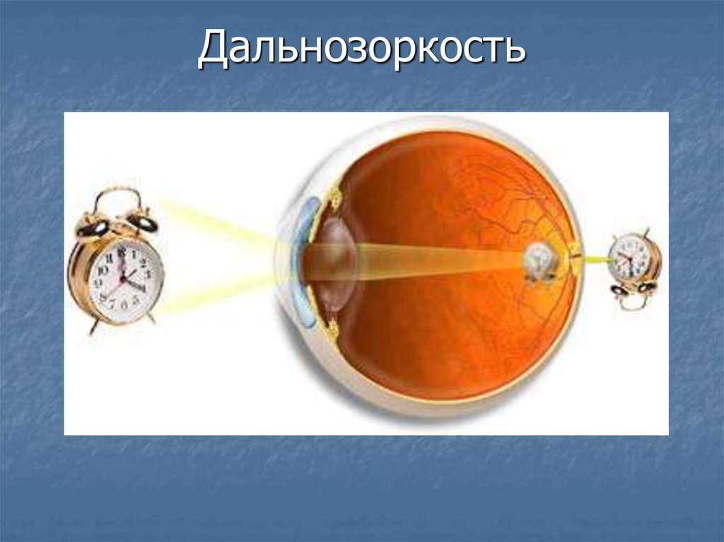 Дальнозоркость