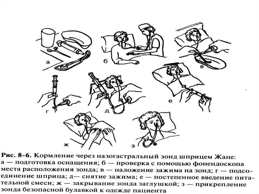 Уход за назогастральным зондом алгоритм сестринское