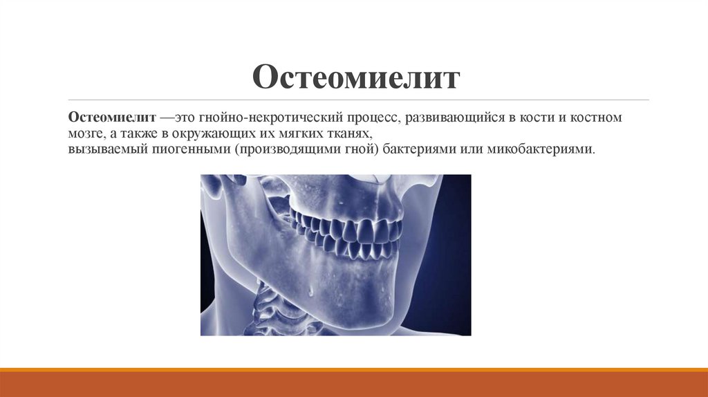 Остеомиелит нижней челюсти мкб. Этиология остеомиелита челюсти. Одонтогенный остеомиелит этиология. Одонтогенный остеомиелит патогенез. Одонтогенный остеомиелит этиология патогенез.