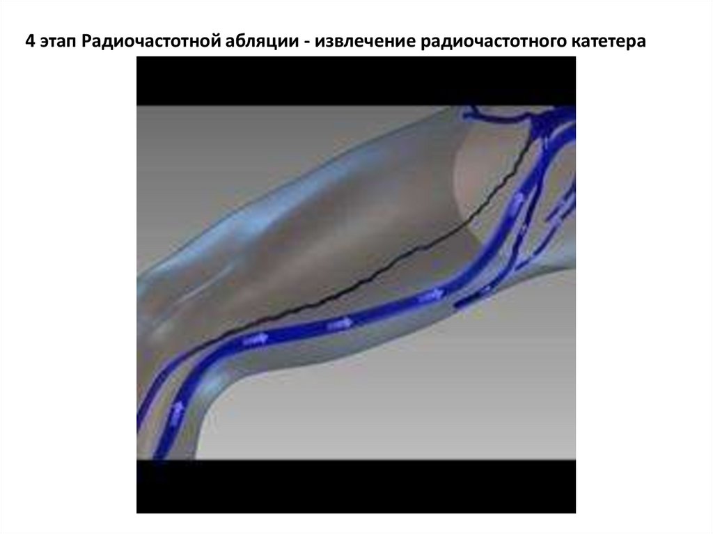 Эндоскопическая хирургия нижних конечностей - презентация онлайн