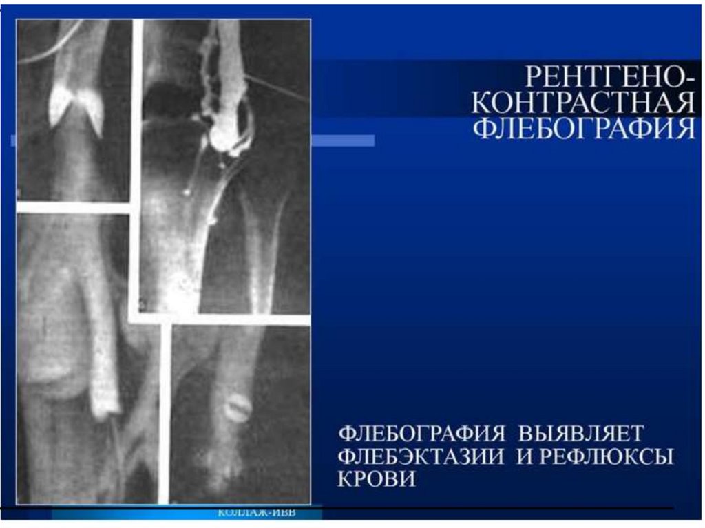 Эндоскопическая хирургия нижних конечностей - презентация онлайн