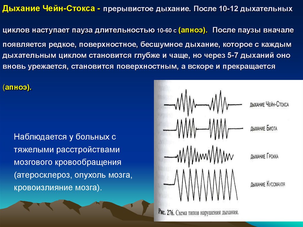 Дыхание чейна стокса что это. Чейна Стокса. Дыхание Чейна Стокса. Длительность паузы импульса. Дыхание Чейна Стокса при.