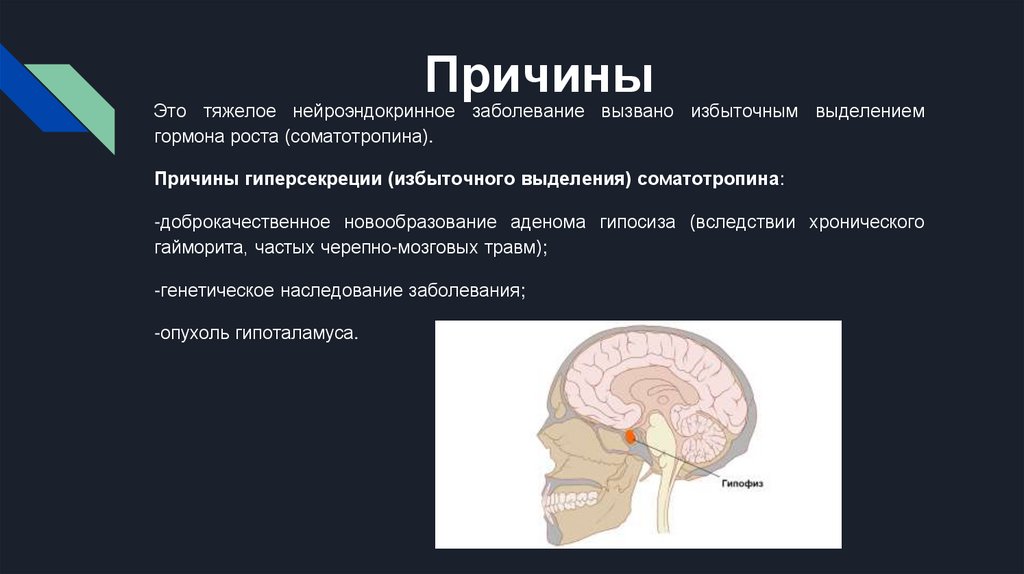 Акромегалия - презентация онлайн