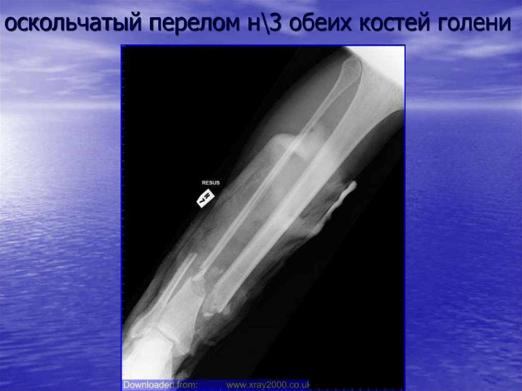 Перелом н 3. Оскольчатый перелом обеих костей голени. Закрытый оскольчатый перелом. Оскольчатый перелом рентген.