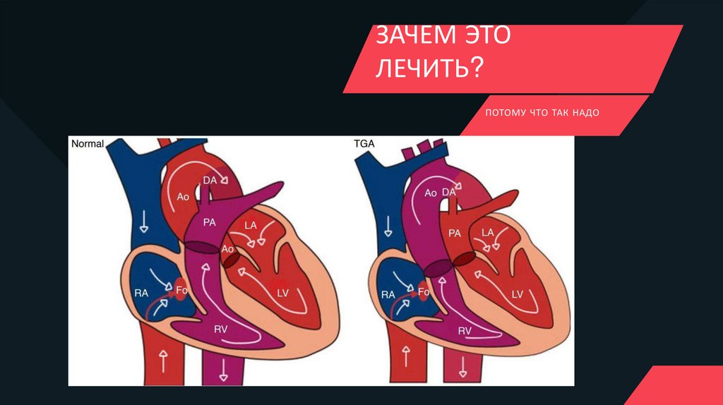Транспозиция магистральных сосудов сердца - презентация онлайн