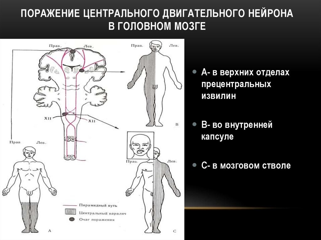 Двигательные нейроны мозга. Синдром поражения центрального нейрона. Синдром поражения центрального мотонейрона. Симптомы поражения центрального двигательного нейрона. Поражение центрального и периферического двигательного нейрона.