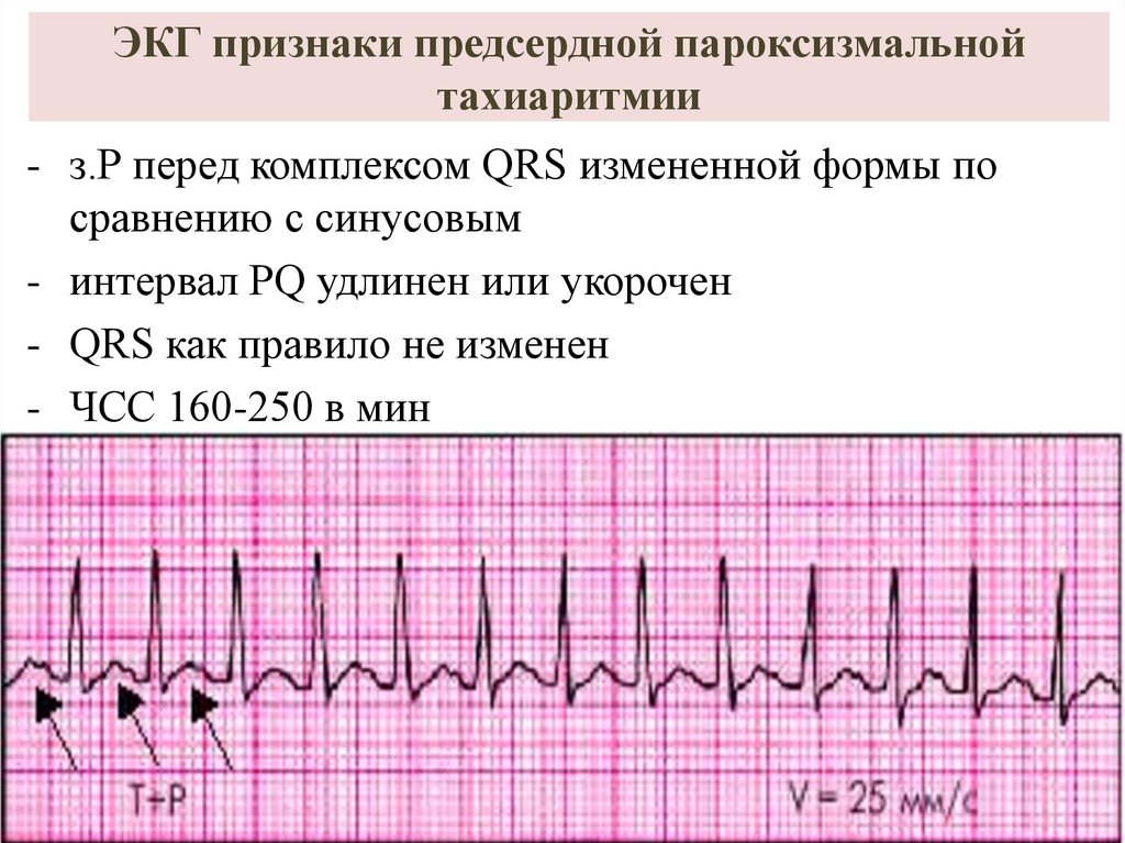 Пароксизма тахиаритмии. ЭКГ-критерии пароксизмальной предсердной тахикардии. Пароксизмальная наджелудочковая тахикардия ЭКГ. ЭКГ при пароксизмальной тахикардии. Тахиаритмия на ЭКГ.