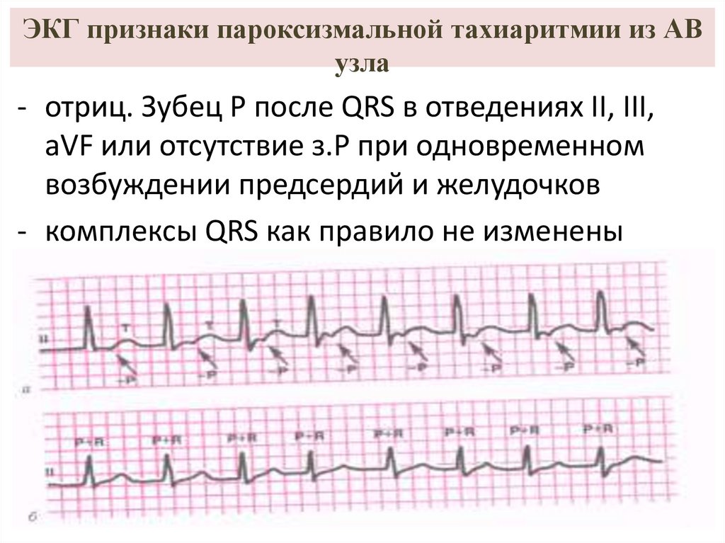 Пароксизмальная тахиаритмия. АВ узел на ЭКГ.