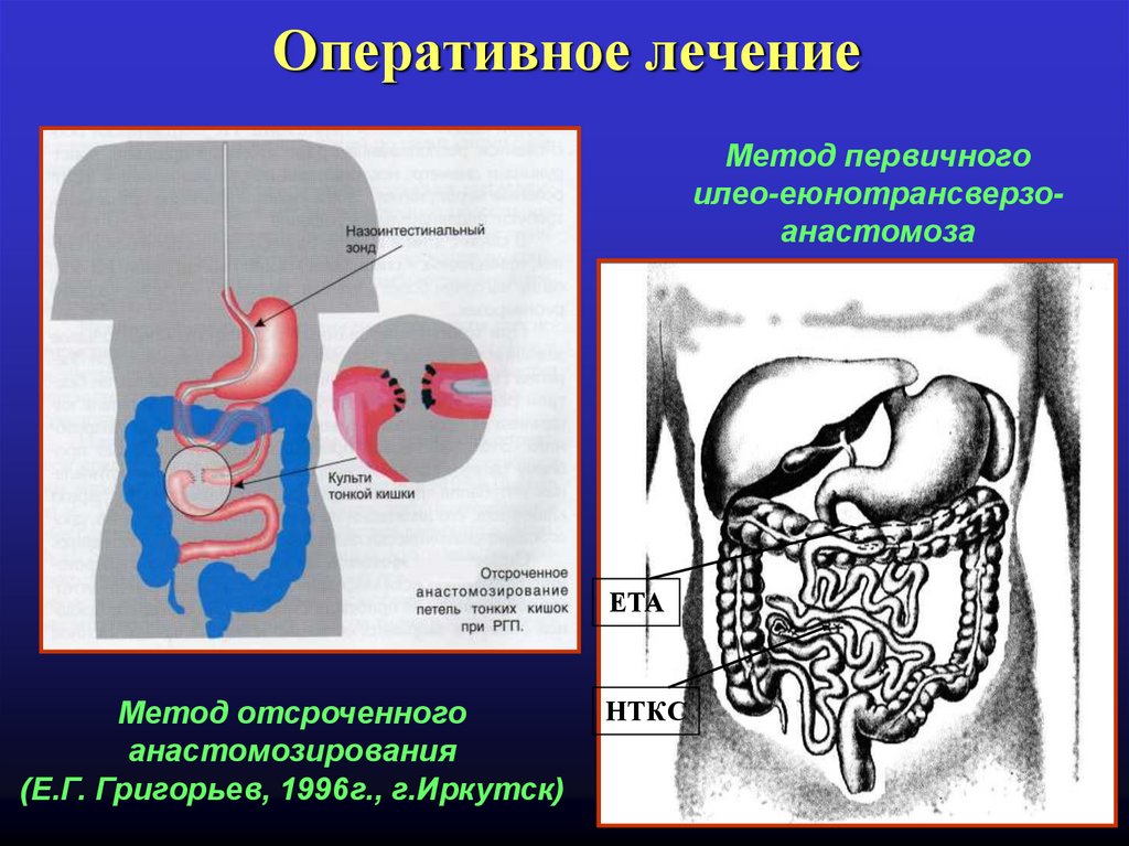 Несформированные свищи