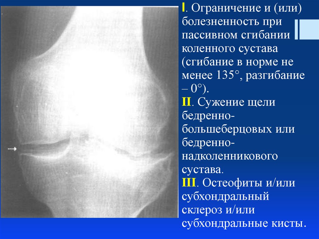 Субхондральный склероз голеностопного. Субхондральный склероз суставных. Субхондральный склероз коленного сустава что это такое. Субхондрального склероза суставных поверхностей. Субхондральный остеосклероз суставных поверхностей.