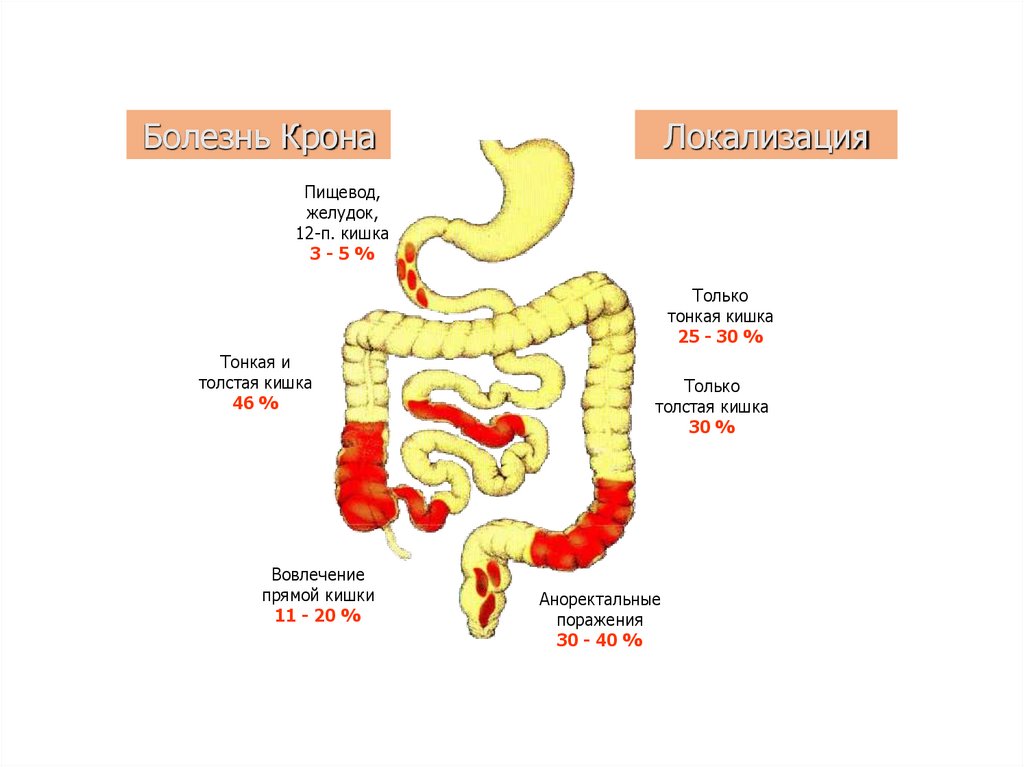 Болезнь крона что это такое