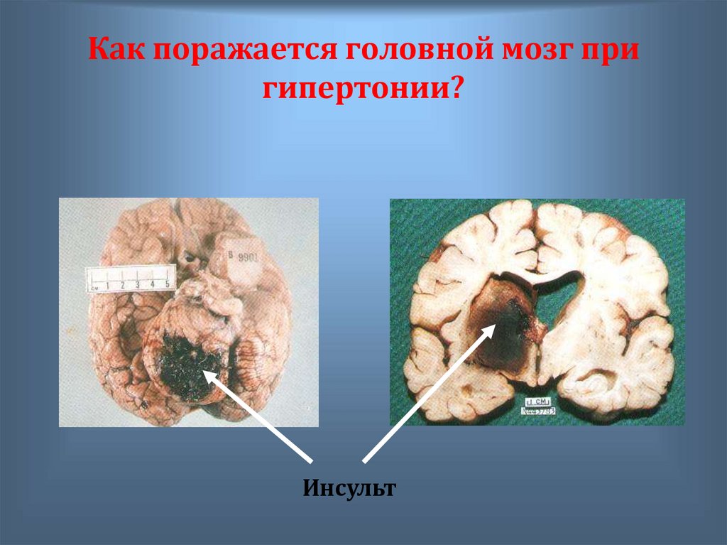Как поражается головной мозг при гипертонии?
