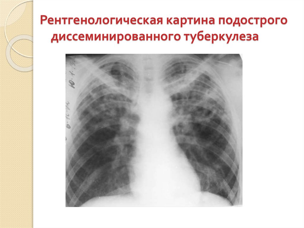Формы диссеминированного туберкулеза