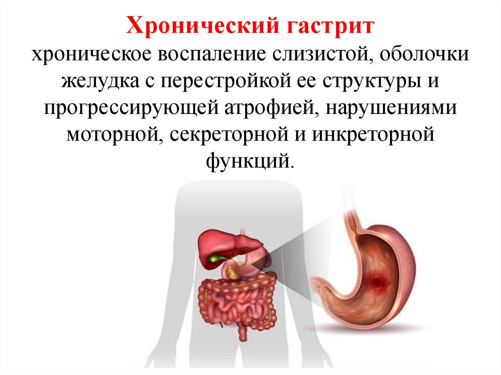Гастриты. Лекция 21 - презентация онлайн