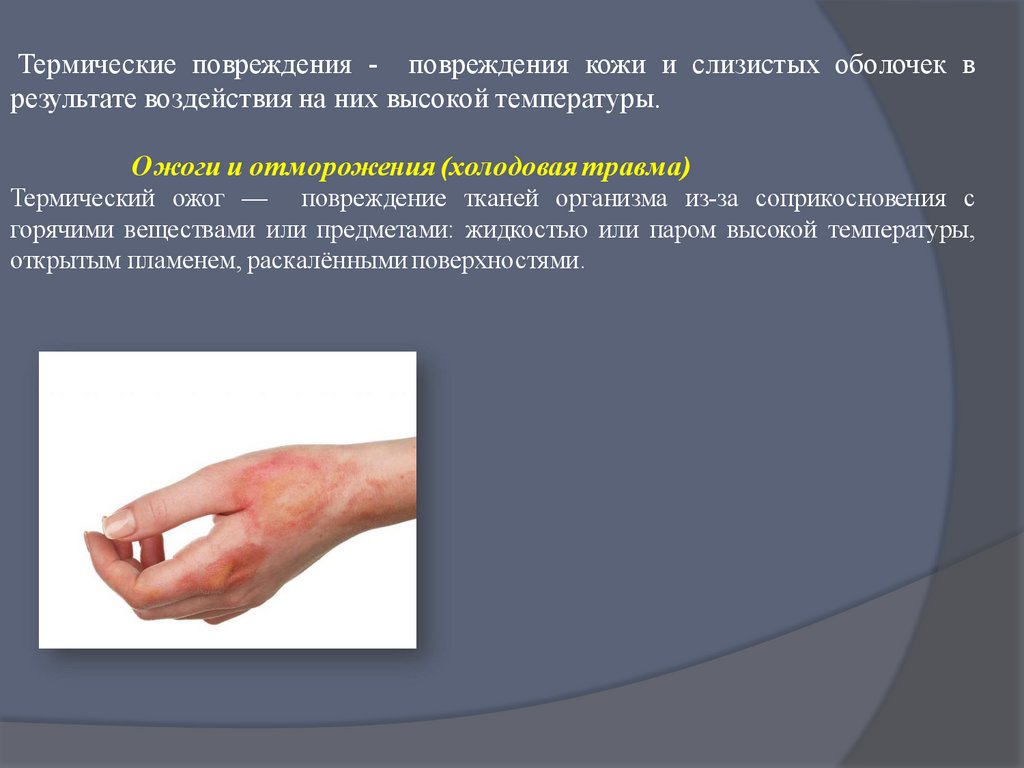 Термические повреждения - online presentation