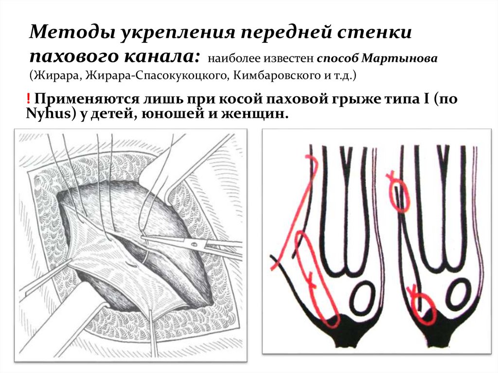 Стенки пахового канала