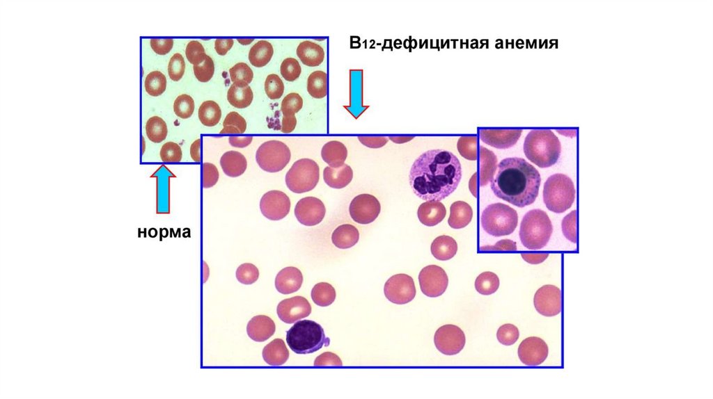 Для в12 дефицитной анемии характерно наличие. B12 дефицитная анемия клиническая картина. пернициозная анемия мегалобластная витамин в12 дефицитная. витамин-b12-дефицитная анеми.