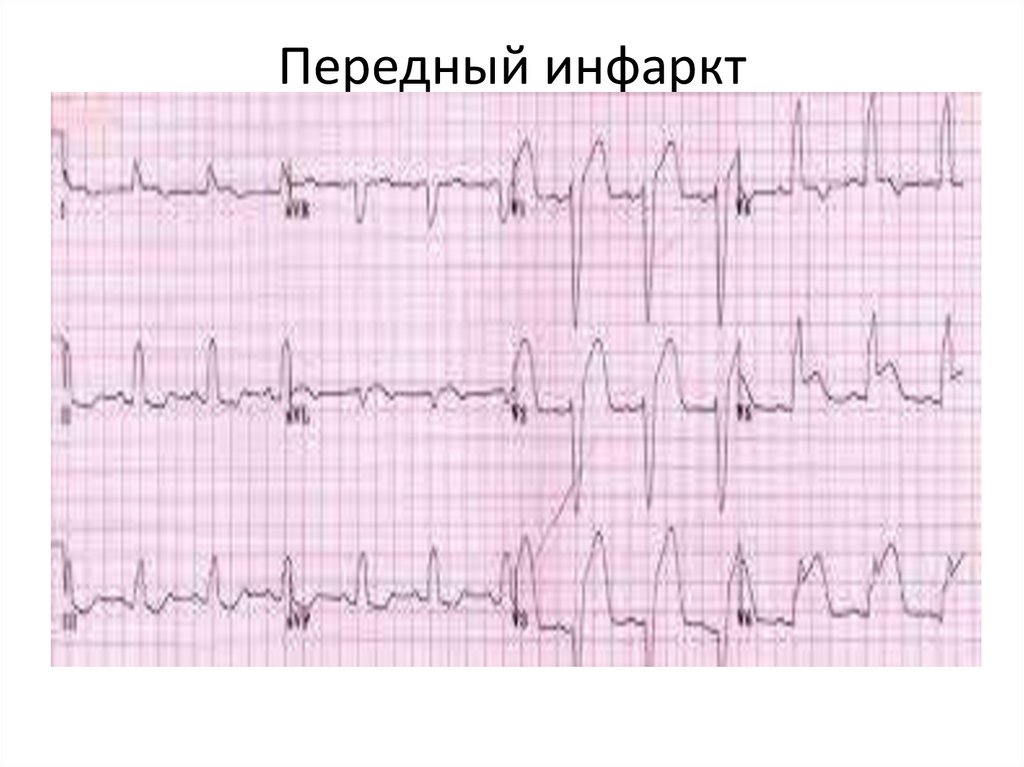 Заболевания сердечно-сосудистой системы - презентация онлайн