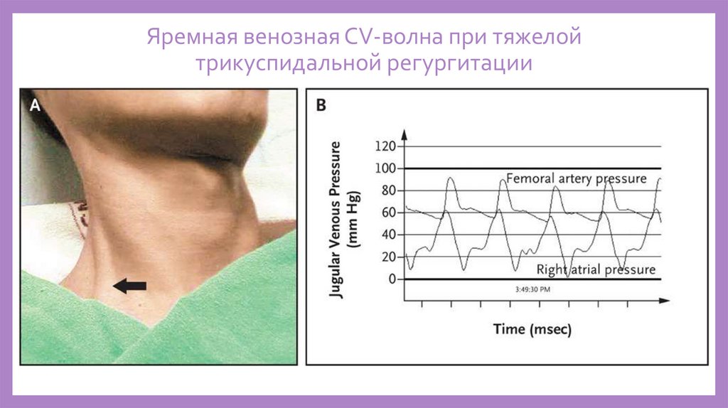 Пульсация яремных вен