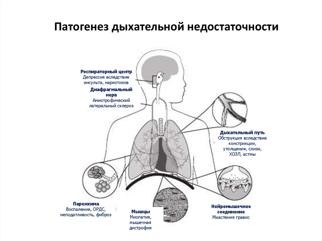 Слабость дыхательной. Механизм развития острой дыхательной недостаточности. Схема патогенеза острой дыхательной недостаточности. Причины острой дыхательной недостаточности схема. Синдром дыхательной недостаточности причины.
