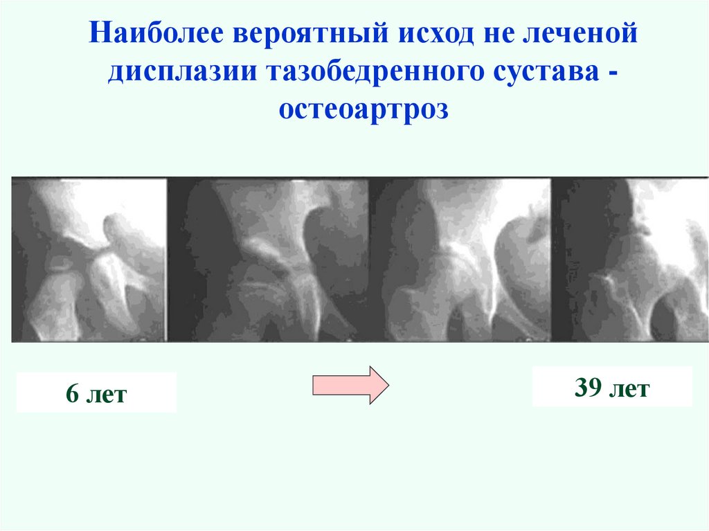 Ацетабулярный угол у детей