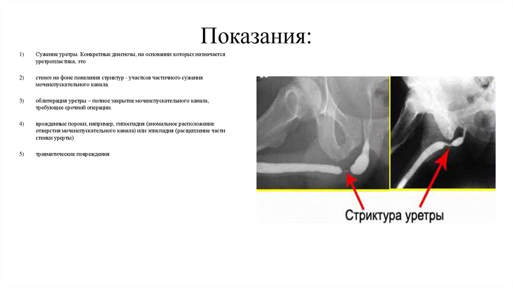 Пластика уретры и полового члена - презентация онлайн