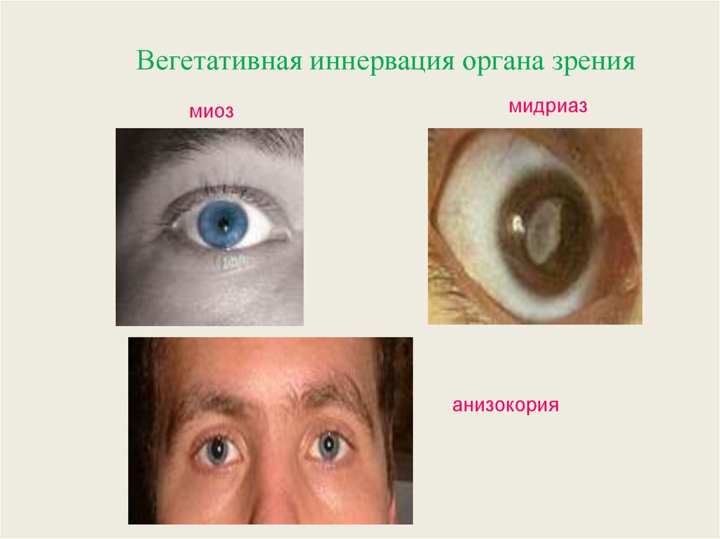 Вид мышечной ткани сужающей и расширяющей зрачок. Паралитический мидриаз. Травматический мидриаз глаза.