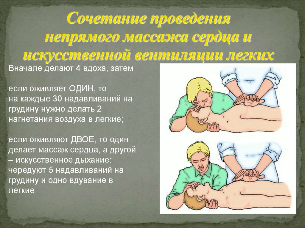 Этапы непрямого массажа сердца. Этапы непрямого массажа сердца. Последовательность при проведении непрямого массажа сердца. Этапы непрямого массажа сердца. Провести непрямой массаж сердца.