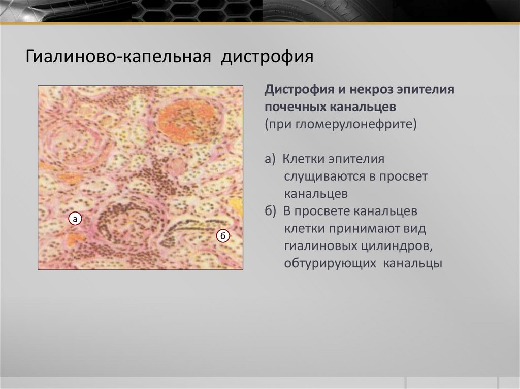 Паренхиматозные дистрофии виды