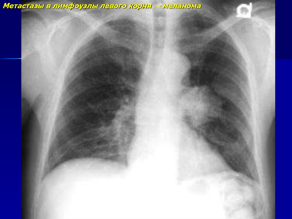 Пошли метастазы в легкие. Объемные образования в легких. Метастазы меланомы в легкие. Область неоплазии в легком.