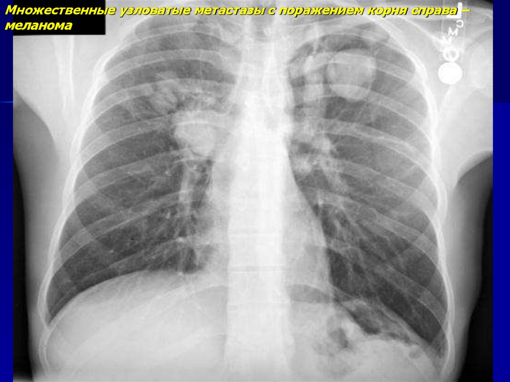 Меланома в легких. Множественные метастазы в легких. Метастазы меланомы в легкие. Метастазы меланомы в легком.