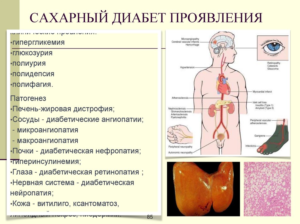 Как проявляется диабет