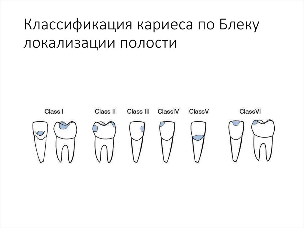 Классификация кариеса