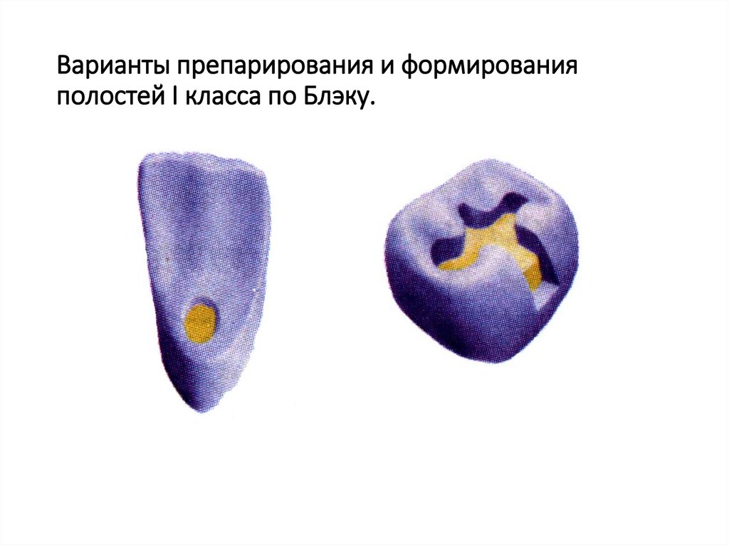 Препарирование 4 класса по блэку. Формирование полостей по Блэку. Препарирование и формирование полости. Полости 1 класса по Блэку. Препарирование кариозных полостей 1 класса по Блэку.