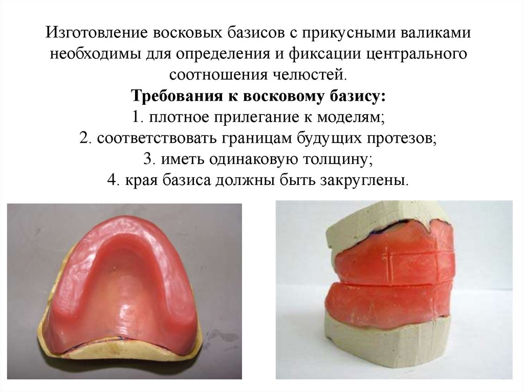 Изготовление воскового базиса с окклюзионными валиками презентация