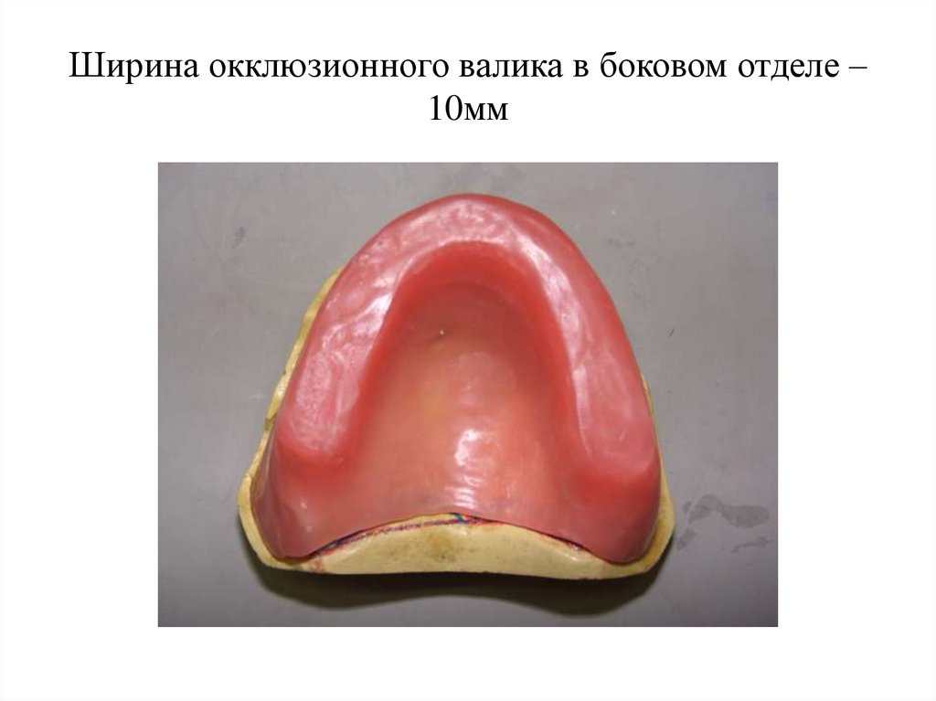 Изготовление воскового базиса с окклюзионными валиками презентация