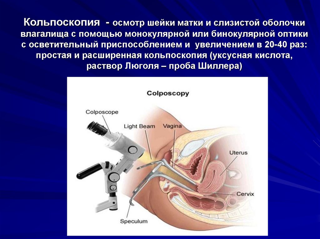 Адекватная кольпоскопическая картина зт 2