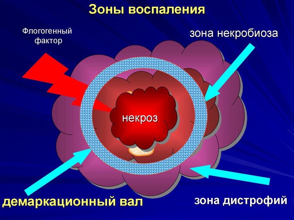 Воспаление 3. Демаркационная зона воспаления при некрозе.