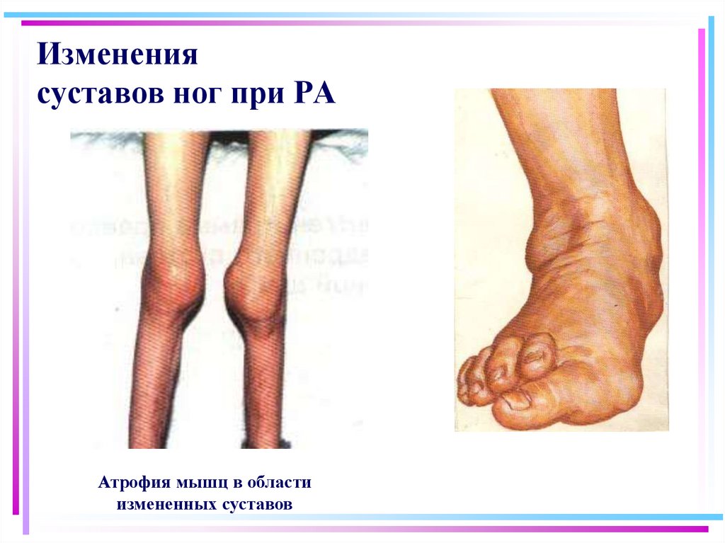 Изменения суставов ног при РА