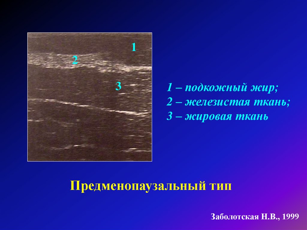 Молочные железы жировые. Железистая ткань молочных желез по УЗИ. УЗИ анатомия молочной железы. Строение молочной железы на УЗИ. Железистая ткань молочной железы на УЗИ.