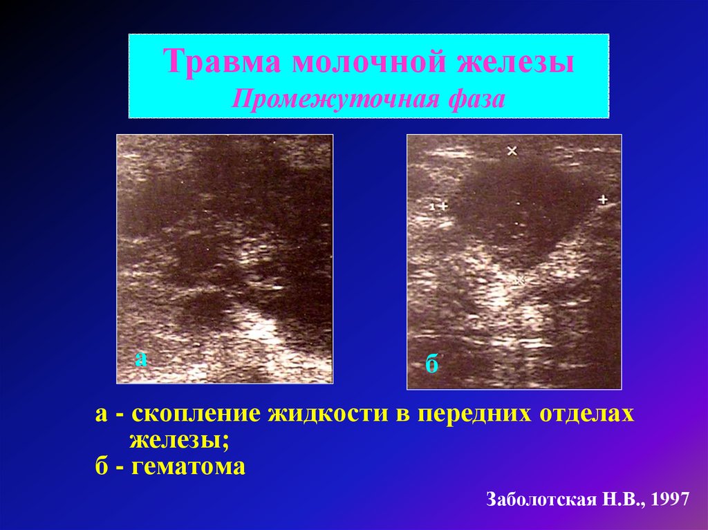 Жидкости в молочных железах. Гематома молочной железы. Гематома молочной железы на УЗИ. Травма молочной железы на УЗИ. Ушиб молочной железы на УЗИ.
