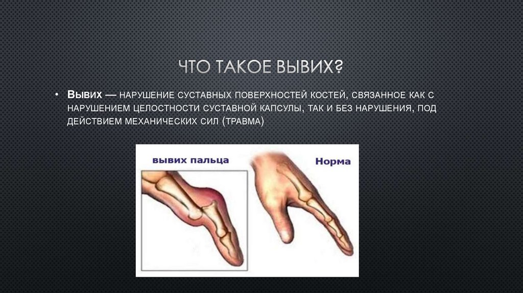 Первая помощь при вывихах и растяжениях - презентация онлайн